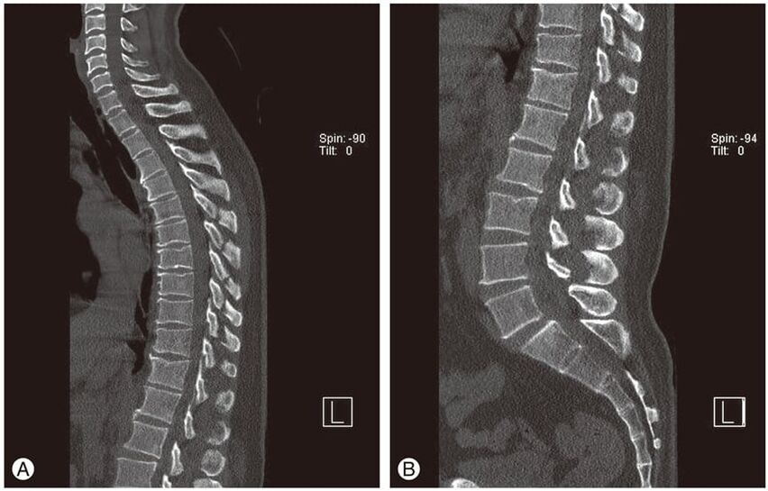 Intervertebraalsete ketaste deformatsioon MRI-piltidel rindkere osteokondroosi korral